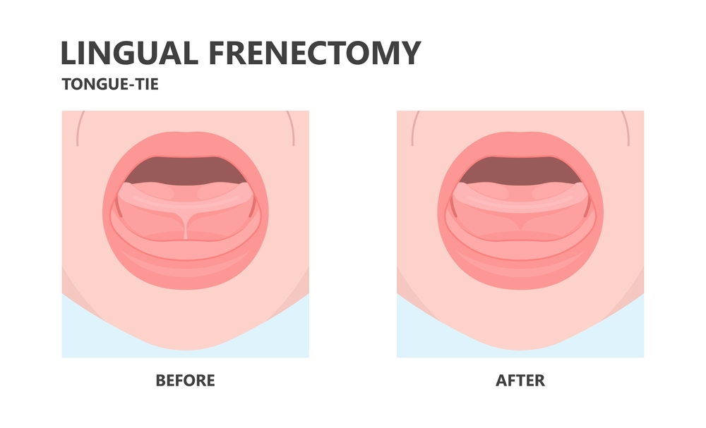 Frenectomy before and after Procedure for Tongue Tie