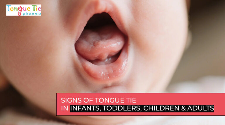 Signs of Tongue Tie in a baby’s mouth with restricted tongue movement